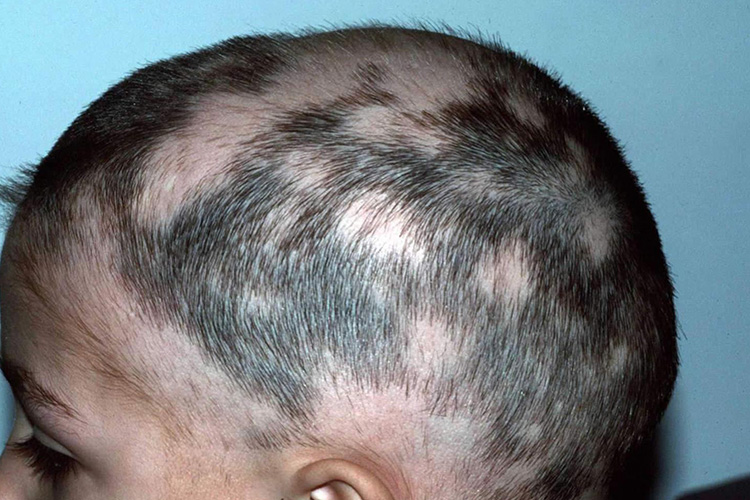 ریزش موی سکه ای در کودکان